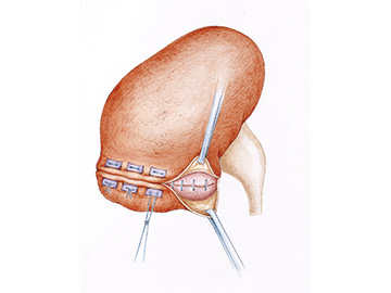 Securing kidney resection line