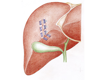 Repair of traumatic liver rupture